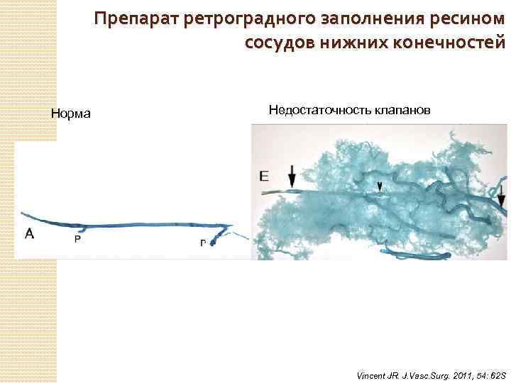 Препарат ретроградного заполнения ресином сосудов нижних конечностей Норма Недостаточность клапанов Vincent JR. J. Vasc.