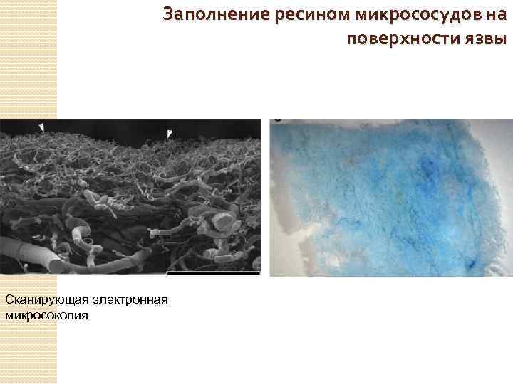Заполнение ресином микрососудов на поверхности язвы Сканирующая электронная микросокопия 