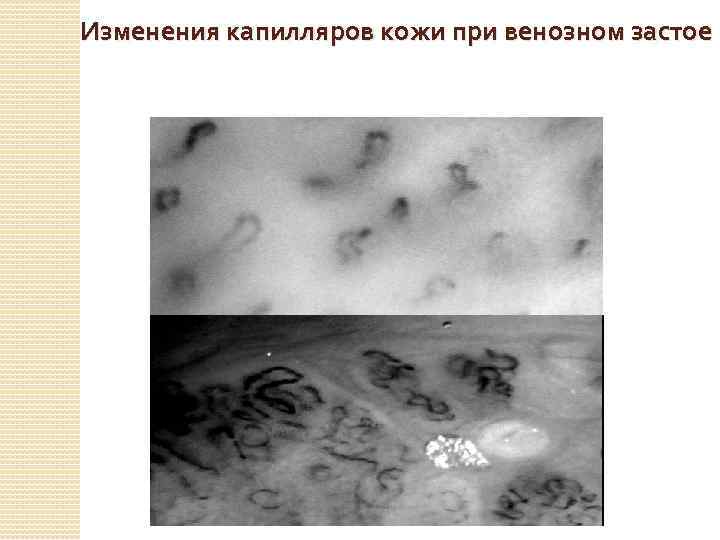 Изменения капилляров кожи при венозном застое 