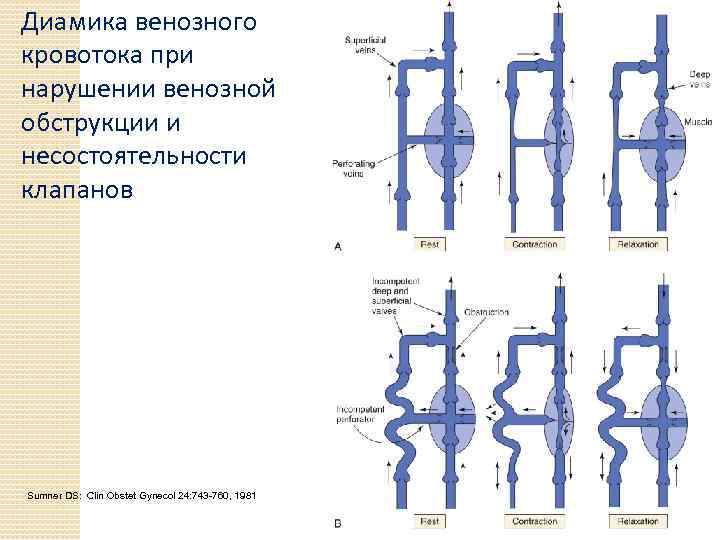 Диамика венозного кровотока при нарушении венозной обструкции и несостоятельности клапанов Sumner DS: Clin Obstet