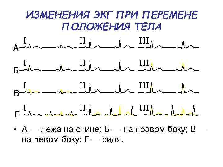 При перемене положения тела. ЭКГ перемена положения тела. Изучение электрической активности миокарда лягушки.