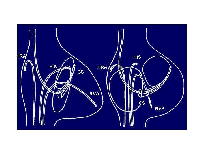 HRA HIS CS HRA RVA CS RVA RAO LAO 