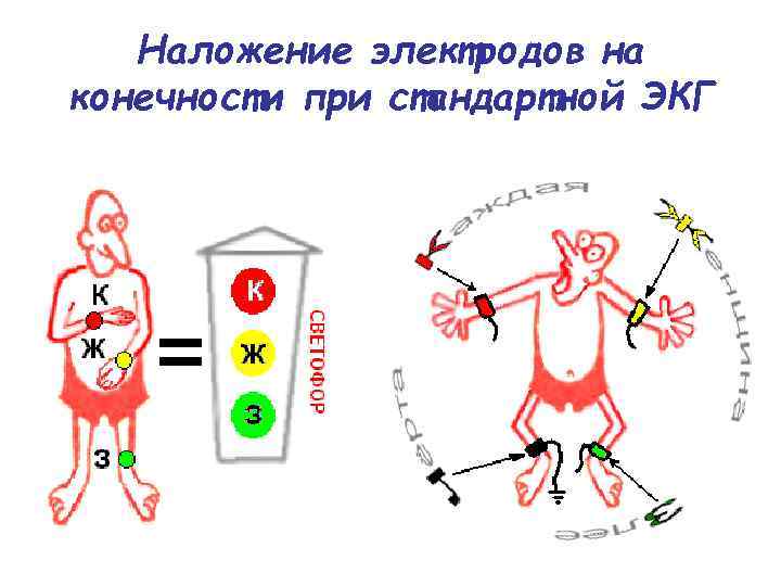 Наложение электродов на конечности при стандартной ЭКГ 