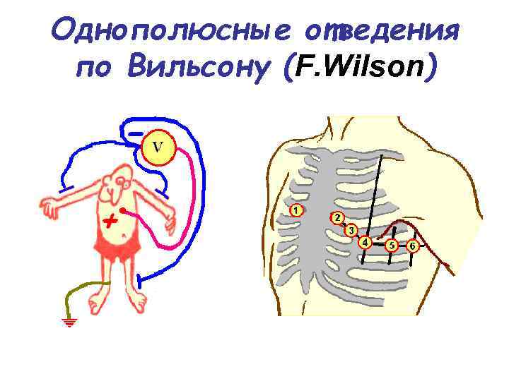 Однополюсные отведения по Вильсону (F. Wilson) 