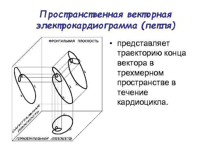 Пространственная векторная электрокардиограмма (петля) • представляет траекторию конца вектора в трехмерном пространстве в течение
