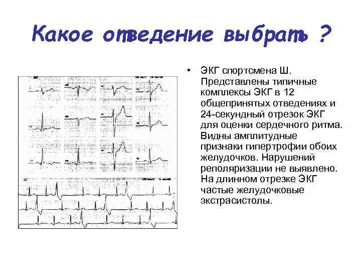 Графическое изображение биотоков сердца называется