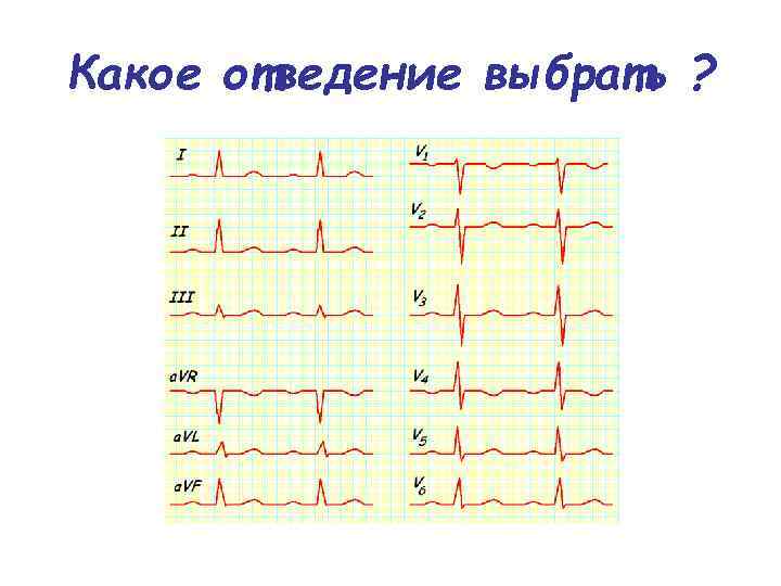 Какое отведение выбрать ? 