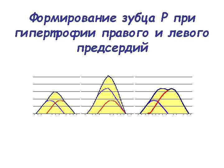 Формирование зубца Р при гипертрофии правого и левого предсердий 