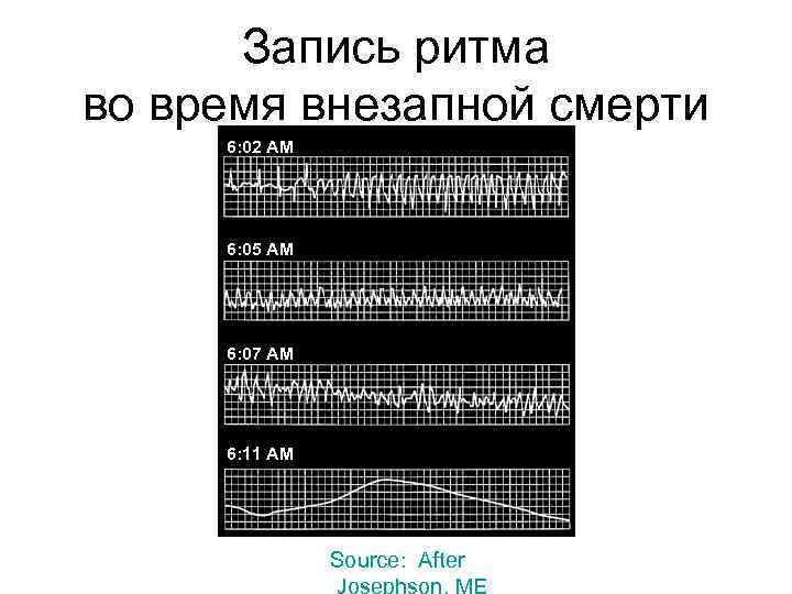 Запись ритма во время внезапной смерти 6: 02 AM 6: 05 AM 6: 07