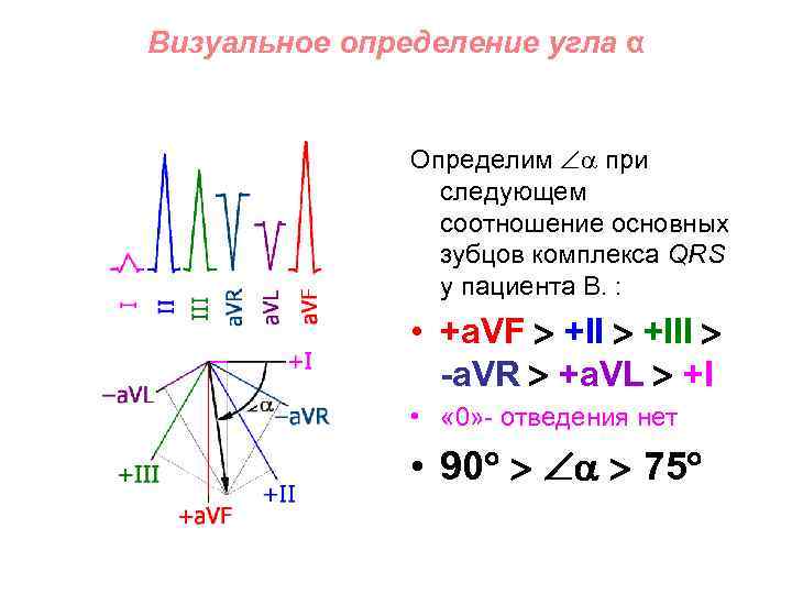 Визуальное определение угла α Определим при следующем соотношение основных зубцов комплекса QRS у пациента