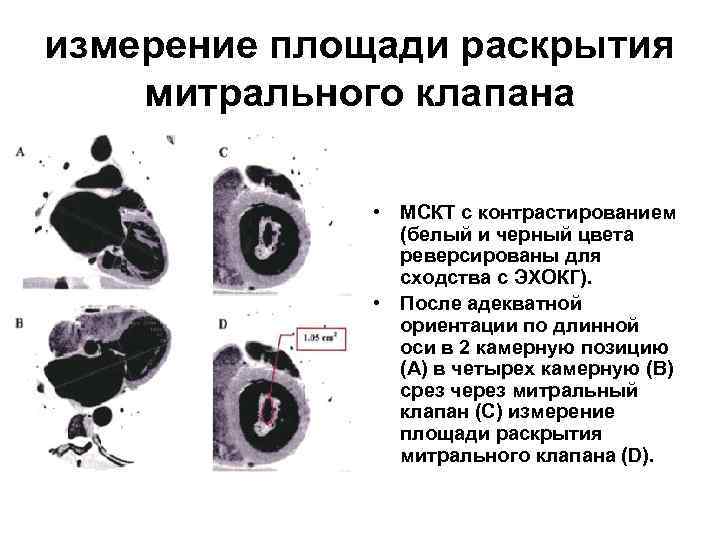 измерение площади раскрытия митрального клапана • МСКТ с контрастированием (белый и черный цвета реверсированы