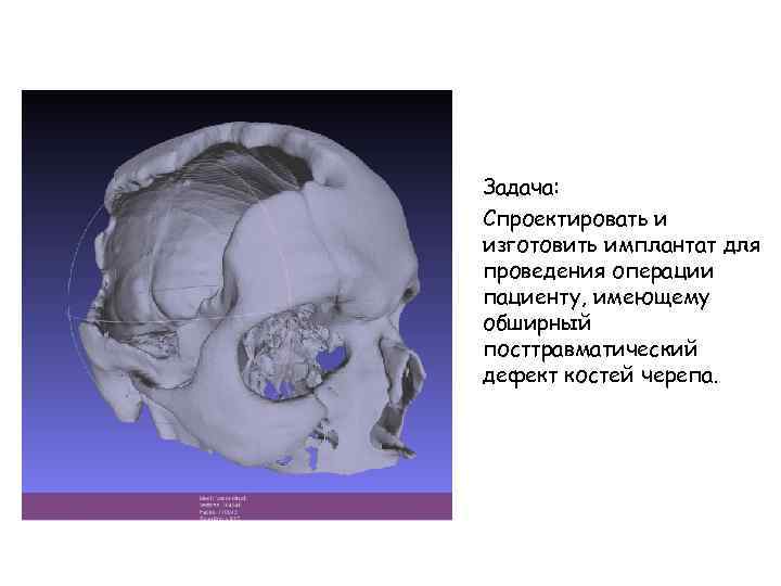 Задача: Спроектировать и изготовить имплантат для проведения операции пациенту, имеющему обширный посттравматический дефект костей