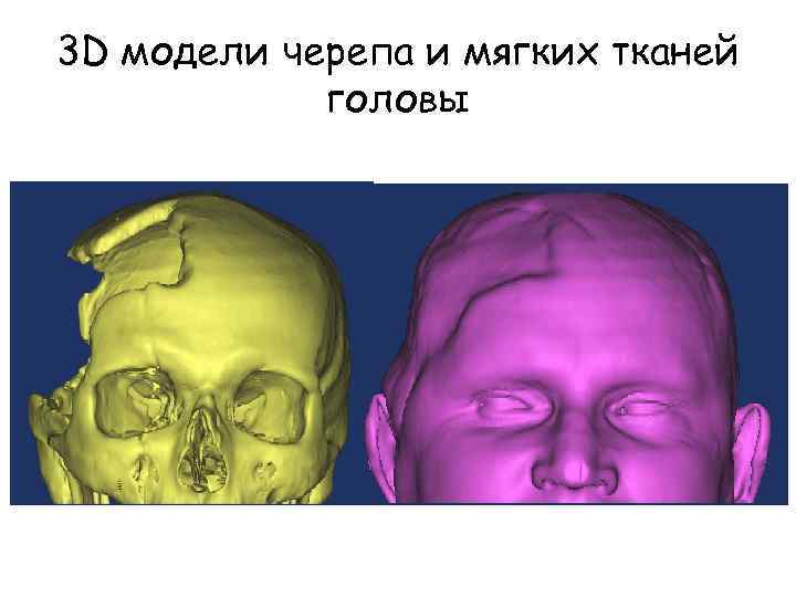3 D модели черепа и мягких тканей головы 