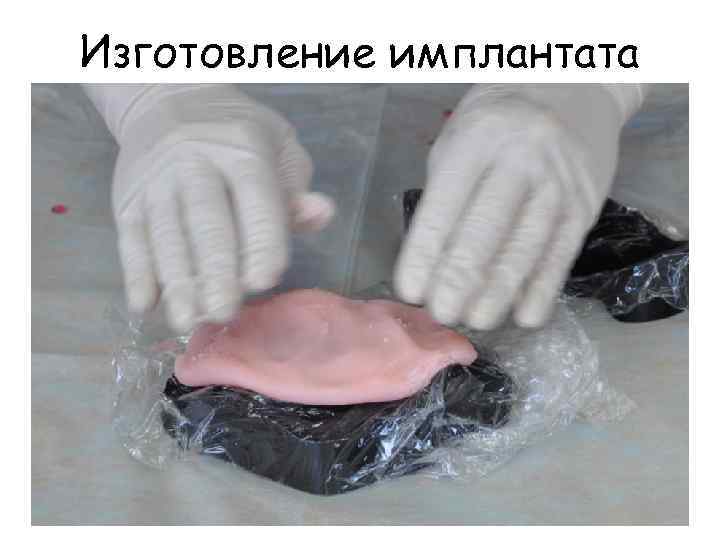 Изготовление имплантата 