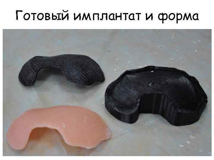 Готовый имплантат и форма 