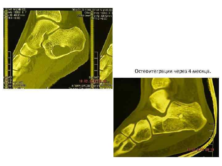 Остеоитеграция через 4 месяца. 