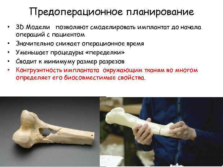 Предоперационное планирование • 3 D Модели позволяют смоделировать имплантат до начала операций с пациентом