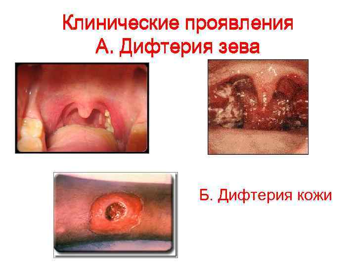 Клинические проявления А. Дифтерия зева Б. Дифтерия кожи 