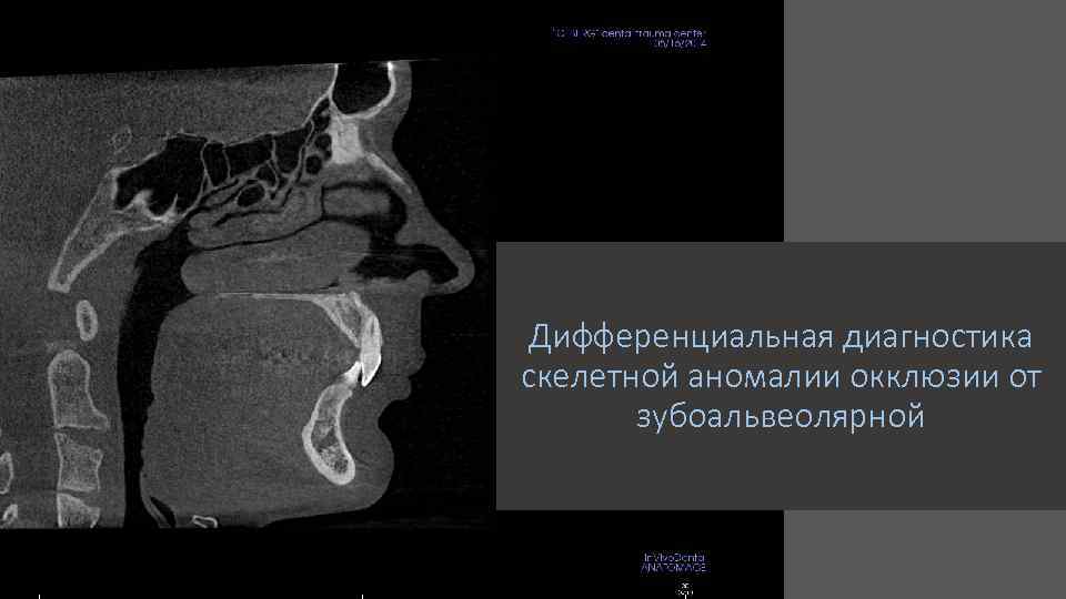 Дифференциальная диагностика скелетной аномалии окклюзии от зубоальвеолярной 