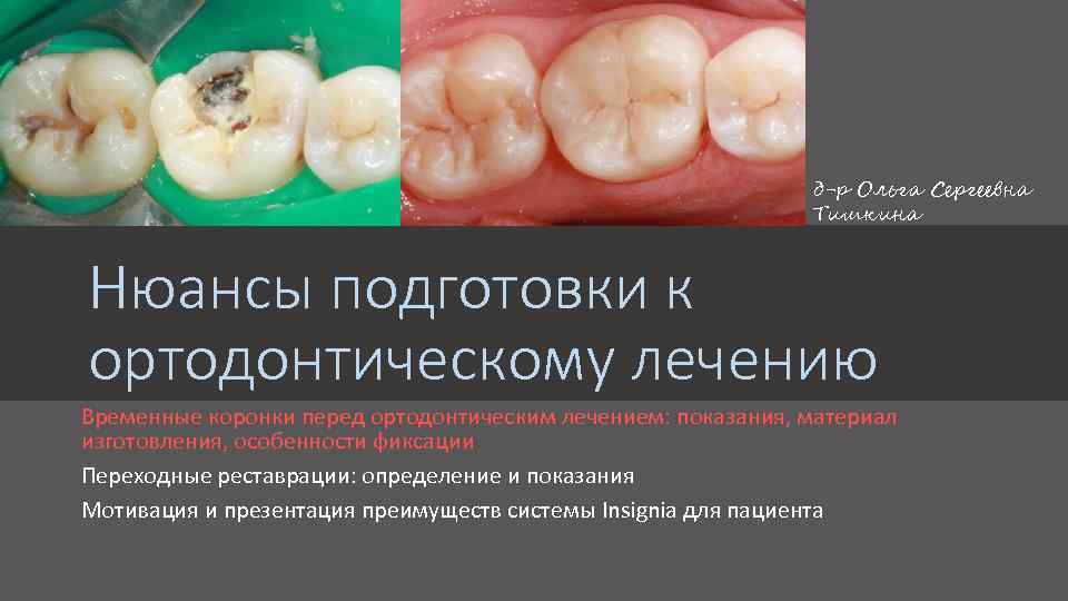 д-р Ольга Сергеевна Тишкина Нюансы подготовки к ортодонтическому лечению Временные коронки перед ортодонтическим лечением: