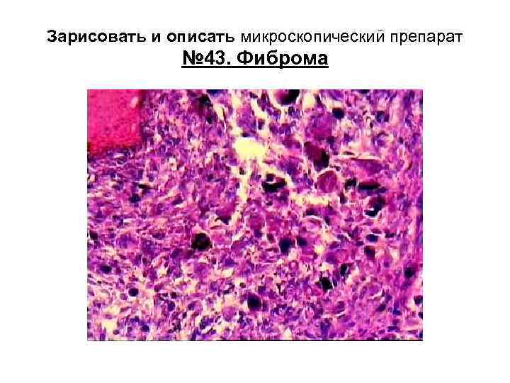 Зарисовать и описать микроскопический препарат № 43. Фиброма 