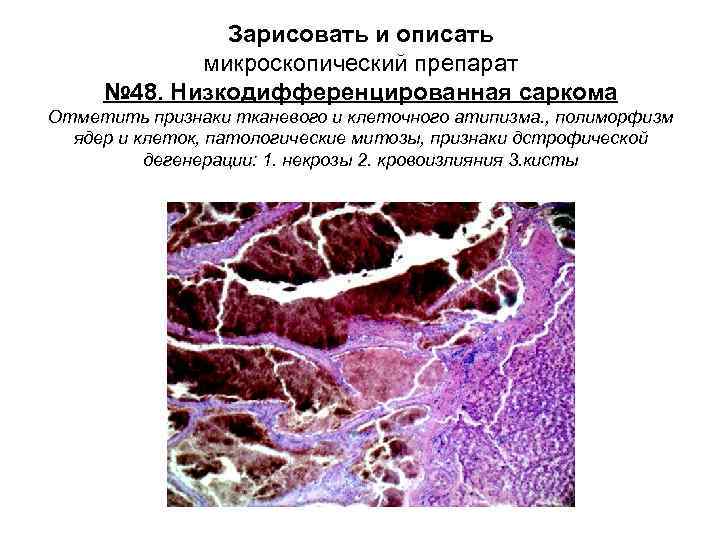 Фибросаркома микропрепарат рисунок