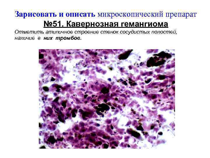 Зарисовать и описать микроскопический препарат № 51. Кавернозная гемангиома Отметить атипичное строение стенок сосудистых