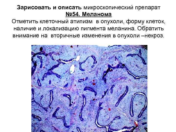 Тканевой атипизм рисунок