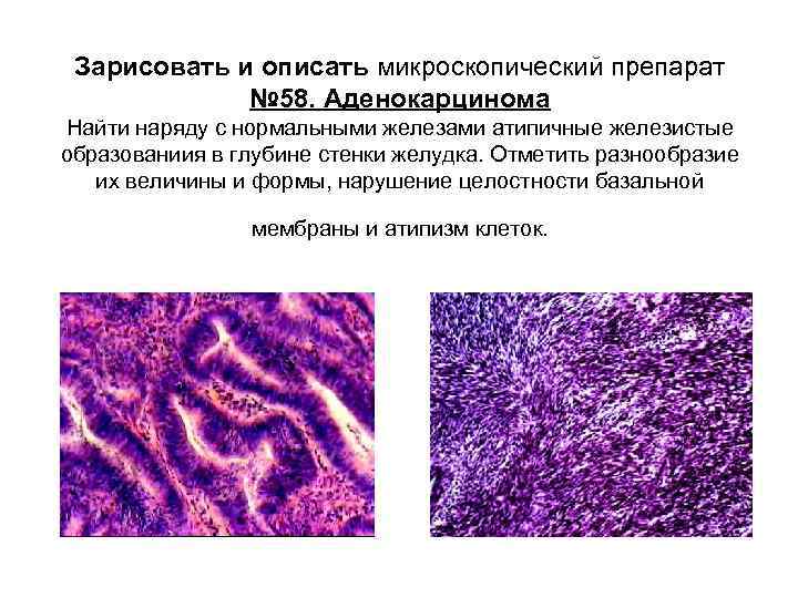 Микропрепарат аденокарцинома желудка рисунок