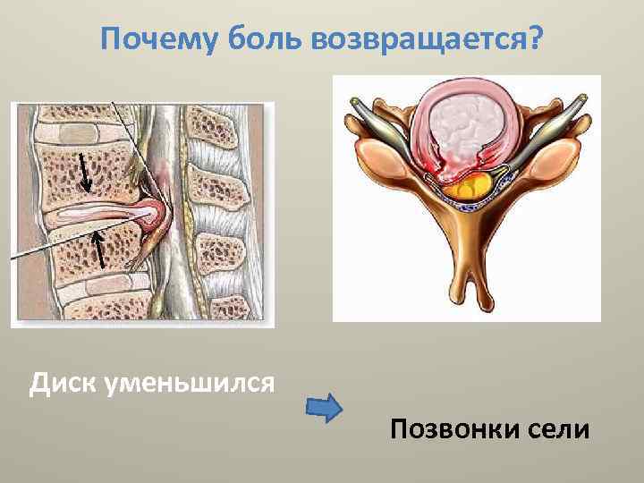 Почему боль возвращается? Диск уменьшился Позвонки сели 