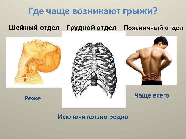 Где чаще возникают грыжи? Шейный отдел Грудной отдел Поясничный отдел Чаще всего Реже Исключительно