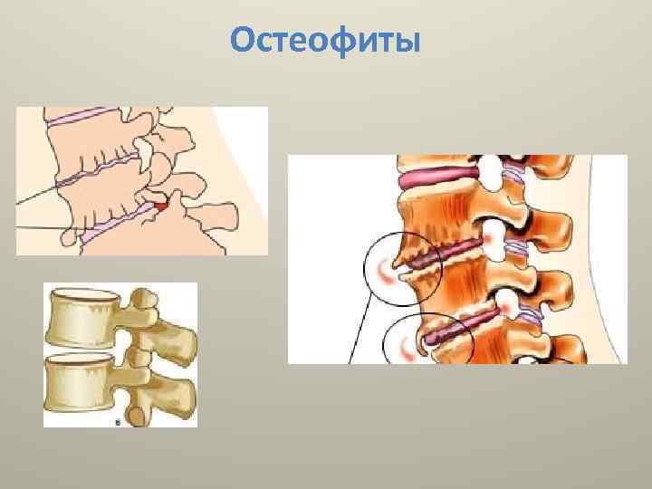 Краевые остеофиты тел позвонков что это такое фото