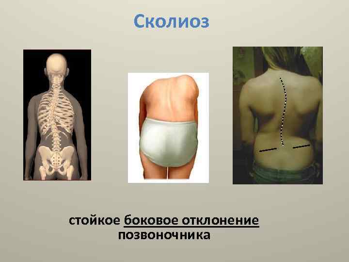 Сколиоз стойкое боковое отклонение позвоночника 