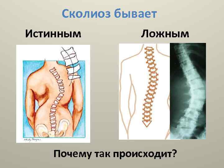 Сколиоз бывает Истинным Ложным Почему так происходит? 
