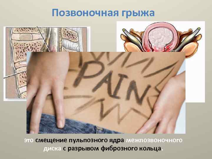 Позвоночная грыжа это смещение пульпозного ядра межпозвоночного диска с разрывом фиброзного кольца. 