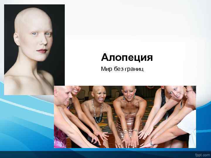 Алопеция Мир без границ 
