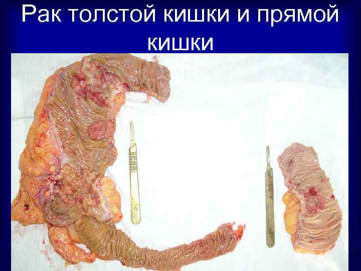 Рак толстой кишки и прямой кишки 