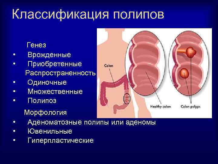 Классификация полипов • • • Генез Врожденные Приобретенные Распространенность Одиночные Множественные Полипоз • •