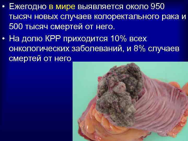  • Ежегодно в мире выявляется около 950 тысяч новых случаев колоректального рака и