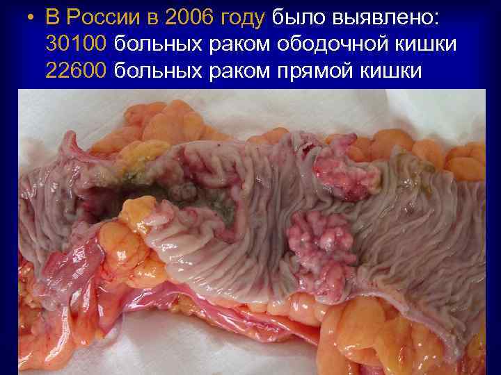  • В России в 2006 году было выявлено: 30100 больных раком ободочной кишки
