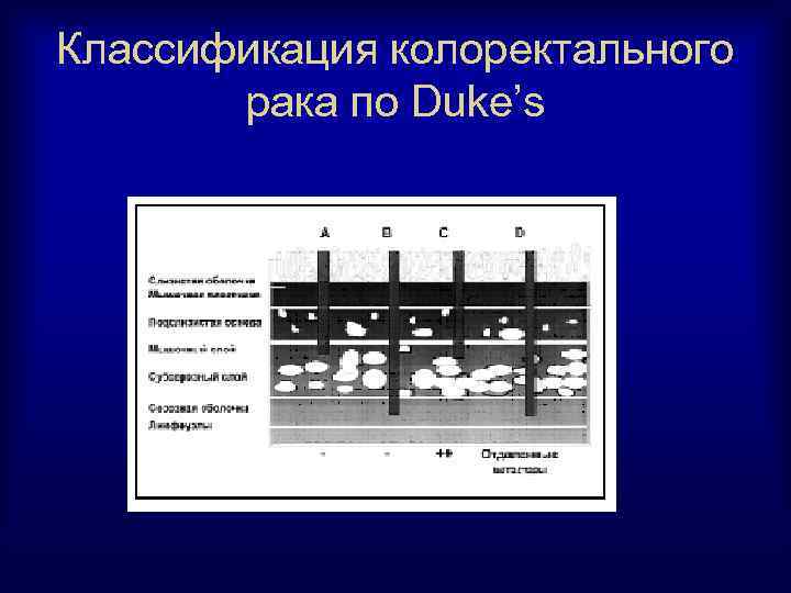 Классификация колоректального рака по Duke’s 