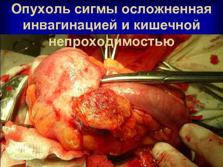 Опухоль сигмы осложненная инвагинацией и кишечной непроходимостью 