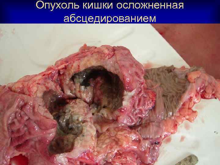 Опухоль кишки осложненная абсцедированием 