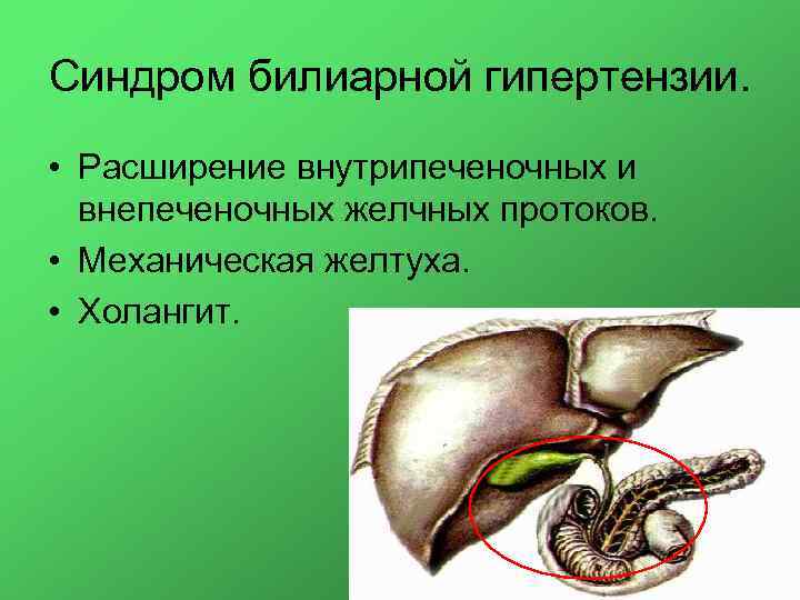 Синдром билиарной гипертензии. • Расширение внутрипеченочных и внепеченочных желчных протоков. • Механическая желтуха. •