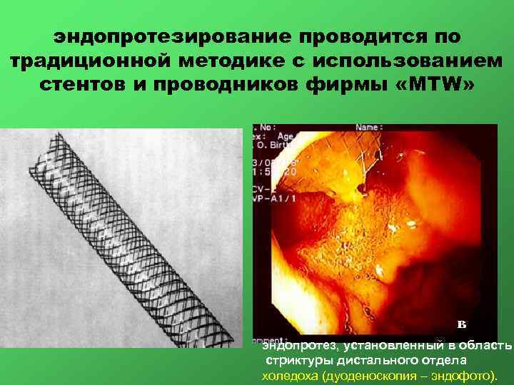 эндопротезирование проводится по традиционной методике с использованием стентов и проводников фирмы «MTW» эндопротез, установленный