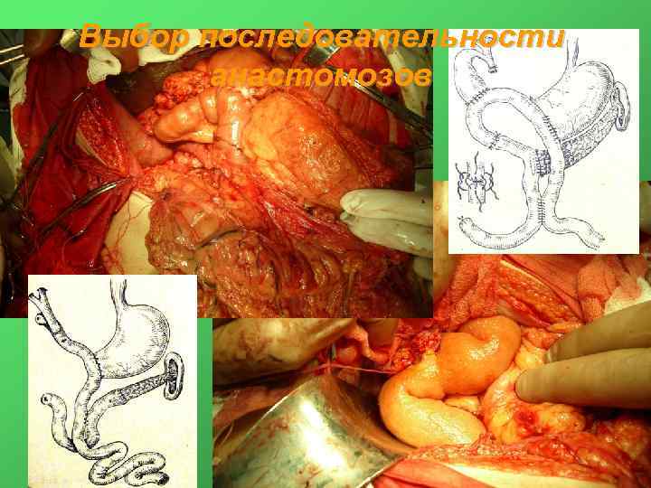 Выбор последовательности анастомозов 