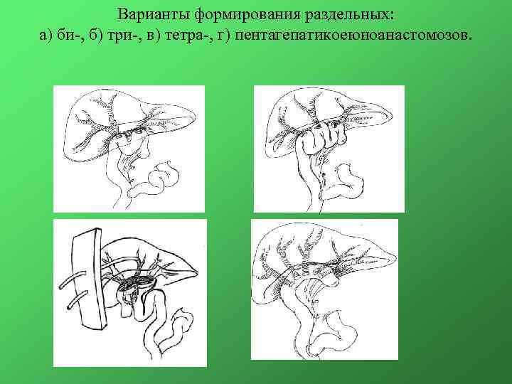 Варианты формирования раздельных: а) би-, б) три-, в) тетра-, г) пентагепатикоеюноанастомозов. а б в