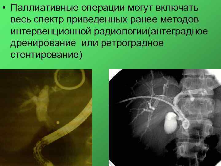  • Паллиативные операции могут включать весь спектр приведенных ранее методов интервенционной радиологии(антеградное дренирование