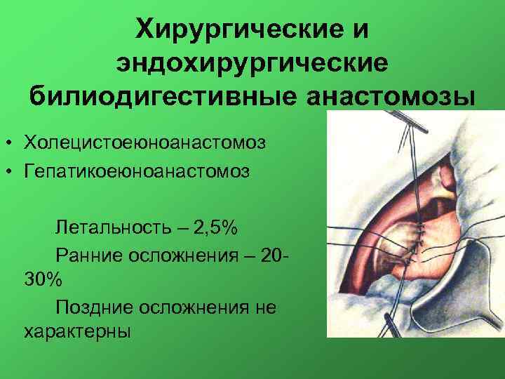 Хирургические и эндохирургические билиодигестивные анастомозы • Холецистоеюноанастомоз • Гепатикоеюноанастомоз Летальность – 2, 5% Ранние