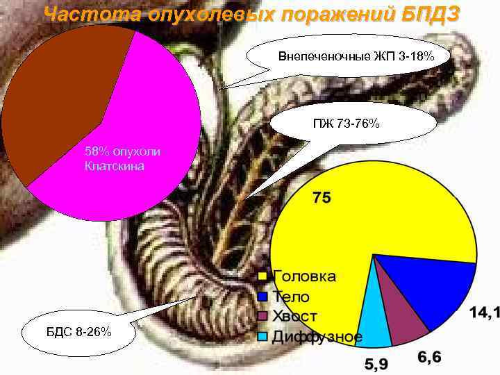 Частота опухолевых поражений БПДЗ Внепеченочные ЖП 3 -18% ПЖ 73 -76% 58% опухоли Клатскина